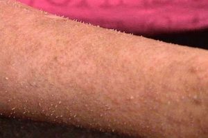 Bệnh Dày Sừng Nang Lông Là Gì? Nguyên Nhân Và Triệu Chứng
