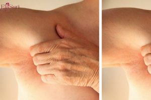 Những Điều Bạn Cần Kiêng Kị Khi Mắc Viêm Lỗ Chân Lông Ở Nách