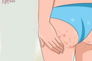 Làm Sao Để Chống Lại Kẻ Thù Mang Tên Viêm Nang Lông Ở Mông
