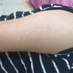 Hỏi Đáp Về Cách Chữa Viêm Lỗ Chân Lông Ở Tay